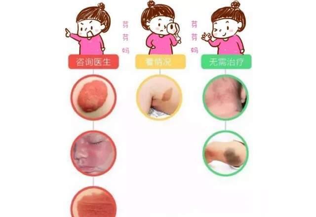 宝宝|胎记是前世的印记?宝宝有这种胎记,一定不能忽视