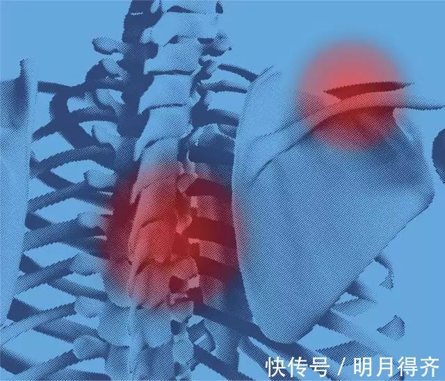 癌症|腰痛、贫血、抵抗力下降...你还不在意小心被这种癌症“盯”上