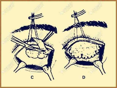 上眼皮下垂做额肌瓣悬吊术改善能管几年？术后会出现闭不上眼的情况吗