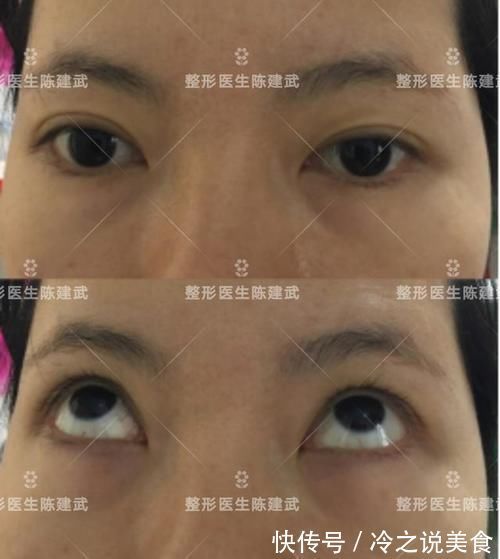 手术|32岁哺乳期女生,分享自己的求美经历:甩掉眼袋和泪沟不烦恼