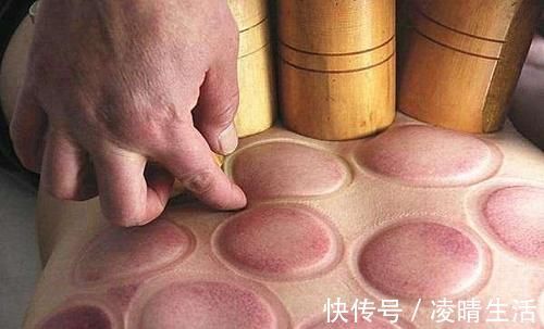 身体|拔完火罐后,身体上那些黑紫色的印记,是拔出来的毒素吗了解下