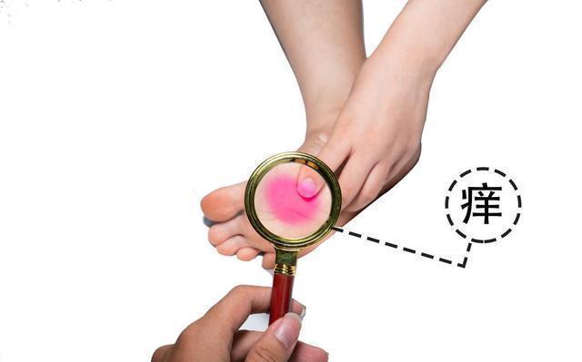 长脚气是什么原因如何治疗和预防复发,一文为你全总结