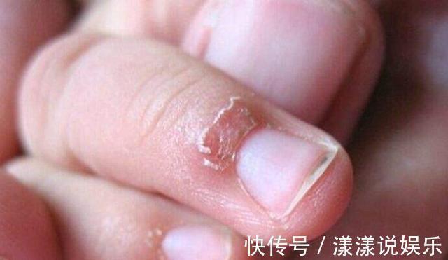 家长|缺锌的孩子,身体主要有6个反应,家长可别疏忽了!