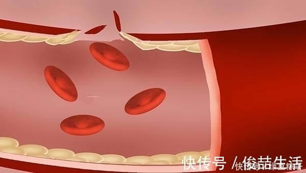 肝脏|得了高血压的人,是不是不能继续喝酒了?若是喝了,会怎么样?