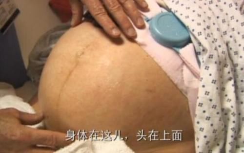 剖腹产|顺产比剖腹产强100倍？剖腹产这3大优点，顺产根本没法比