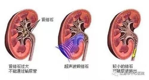 超声微课堂7——肾结石与肾结晶的区别与联系