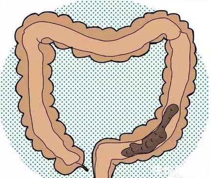 苦瓜|老便秘终于通了!只要一块姜,就排出4斤黑臭宿便,口臭也没了