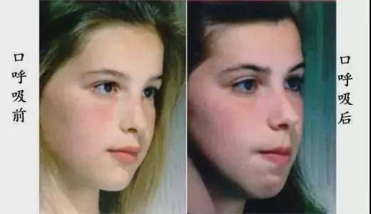嘴巴|长时间用嘴巴呼吸的人,真的会慢慢变丑吗?