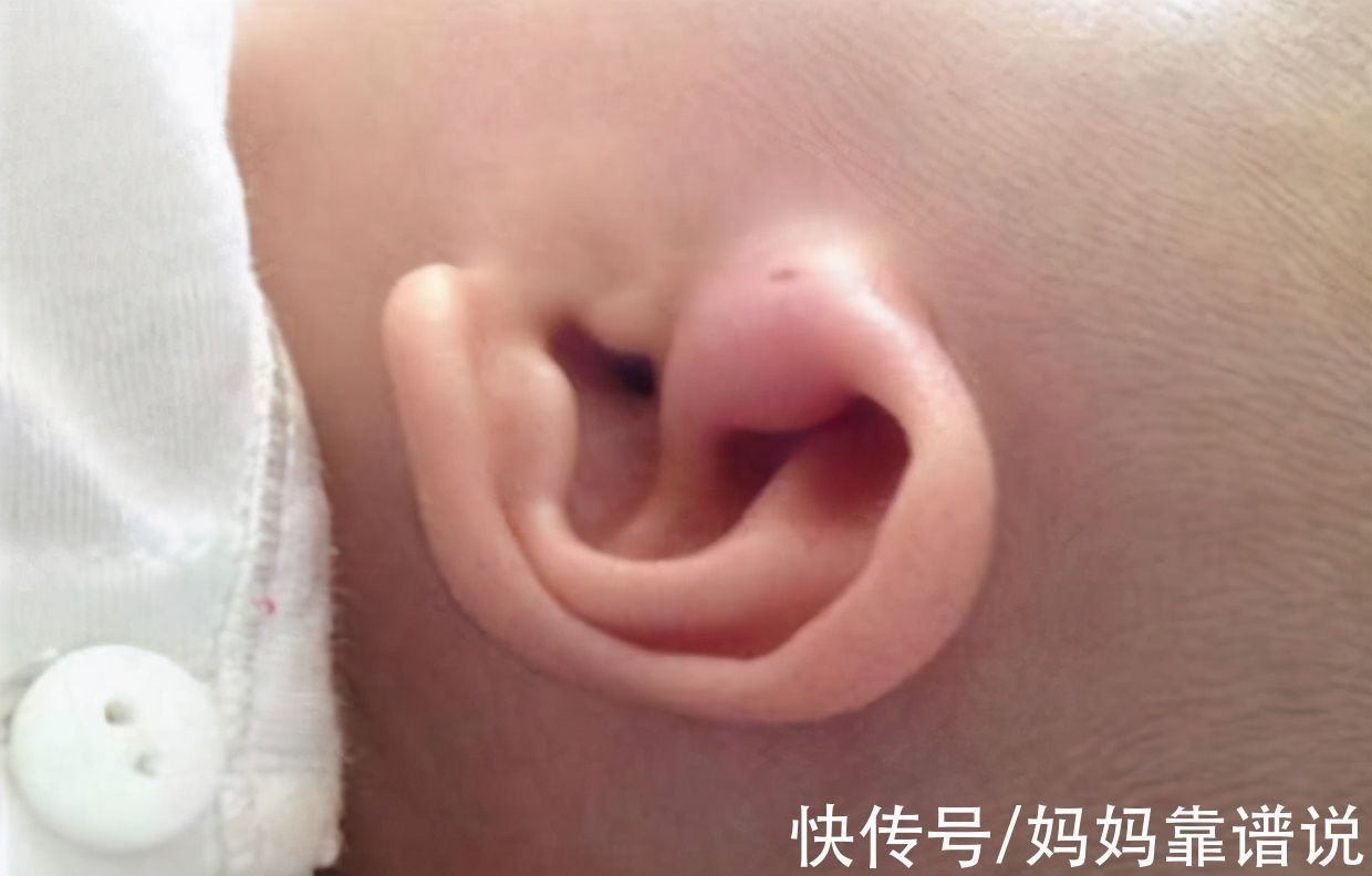 小孔|3岁男童耳边长“聪明孔”,奶奶用手挤,却害了孩子