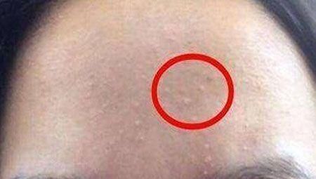 现象|三种现象证明你脸上长了螨虫,还在用醋洗脸吗,难怪没效果