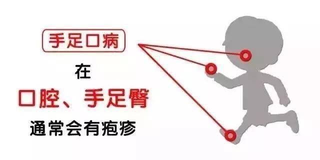 疱疹|预防秋季疱疹性咽峡炎以及手足口病温馨提示——德谚·东头幼儿园