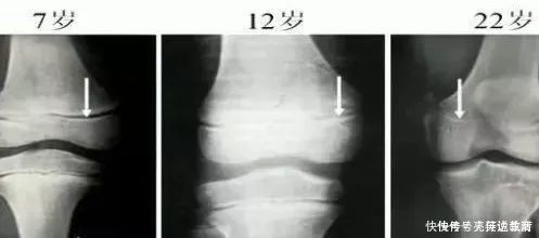 忒咪|“娘矮矮一窝”有道理吗?跳出长高误区,抓住“生长要素”是关键