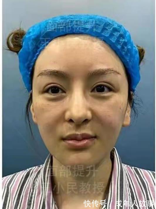 拉皮 拉皮除皱王小民教授32岁做小拉皮,变化有多大!