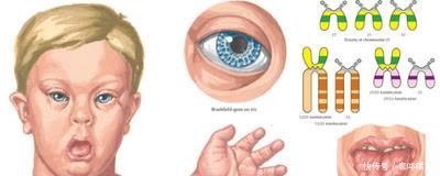 21三体综合症|外国宝妈不顾反对生下“唐氏宝宝”,网友坦言:都有一个共同点!