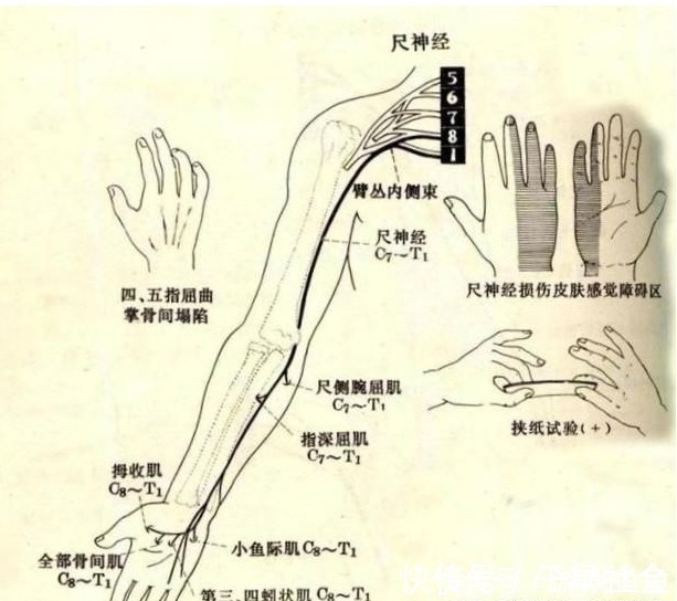 腕管|这几种病都能引起手麻，容易和颈椎病混淆，究竟如何区分好？