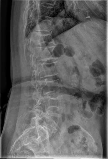 椎体|脊柱常见肿瘤及肿瘤样病变的几种影像学表现，你都见过吗？