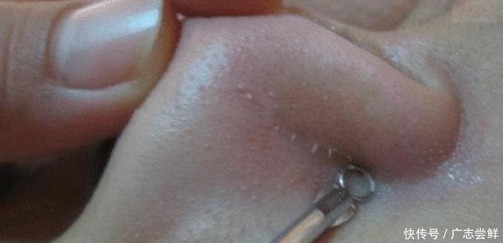 抿紧下巴后突起的“白疙瘩”,千万要注意,这是螨虫的真身吗?