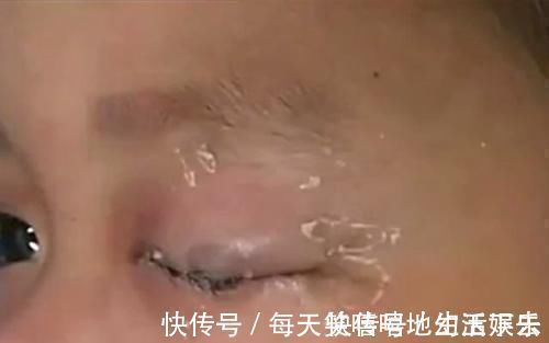 胶水|4岁儿子误将502滴进眼睛,妈妈一个举动挽救孩子,医生:睿智