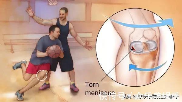 保养|膝盖不如铁,且行且珍惜!如何保养膝关节,医生好好给您支几招儿