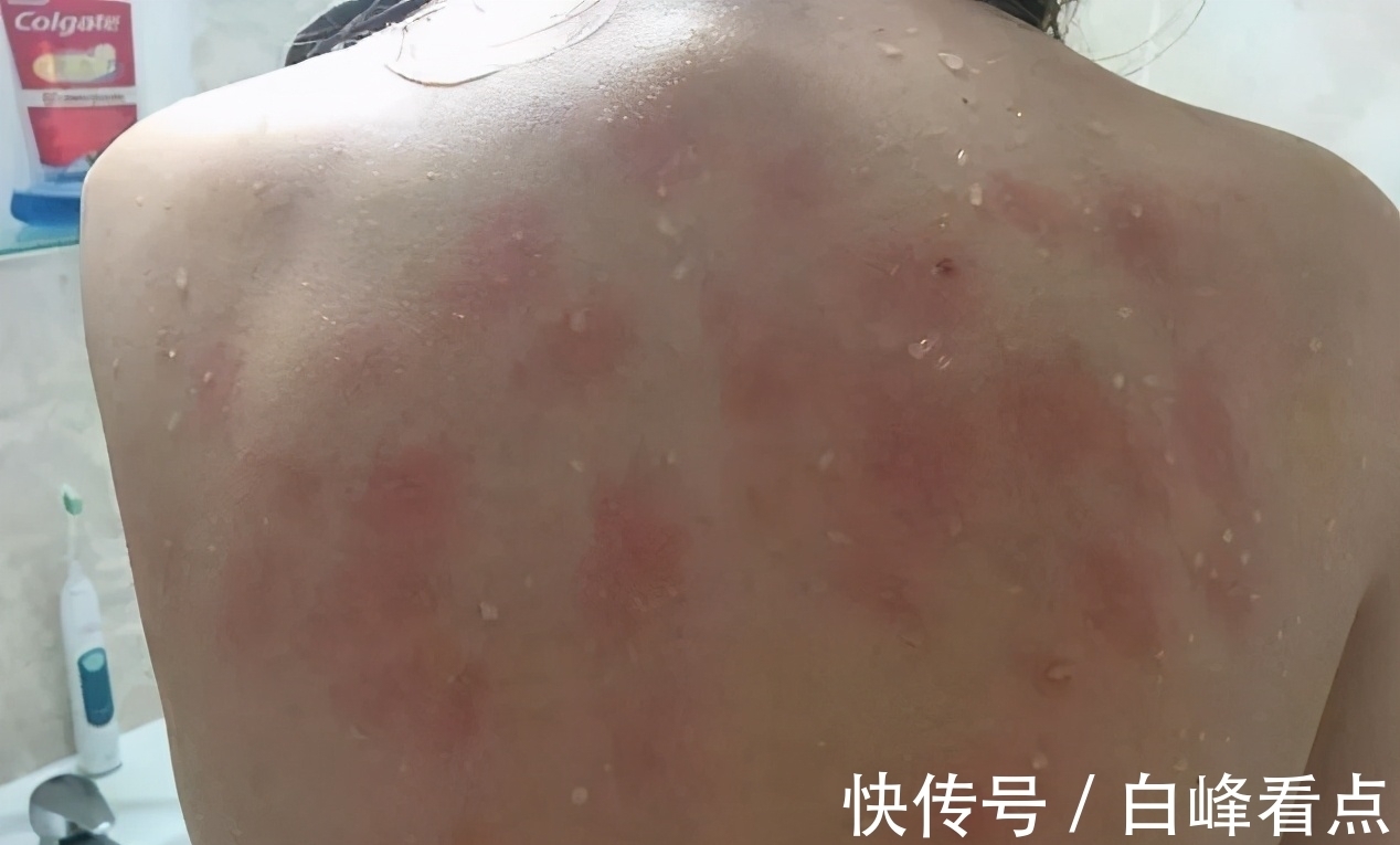 小姑娘|对水过敏的女孩,洗一次澡都可能要她的命,出汗流泪都痛苦