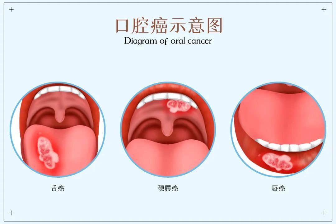 上皮细胞|口腔溃疡超过两周不愈，要警惕！有可能是口腔癌！