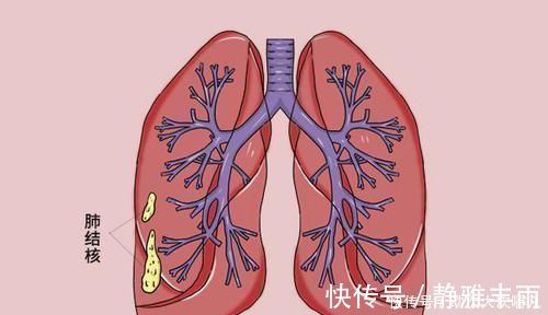 肺部|肺部发现小节，良性结节的特征是什么哪些变化在提示癌症