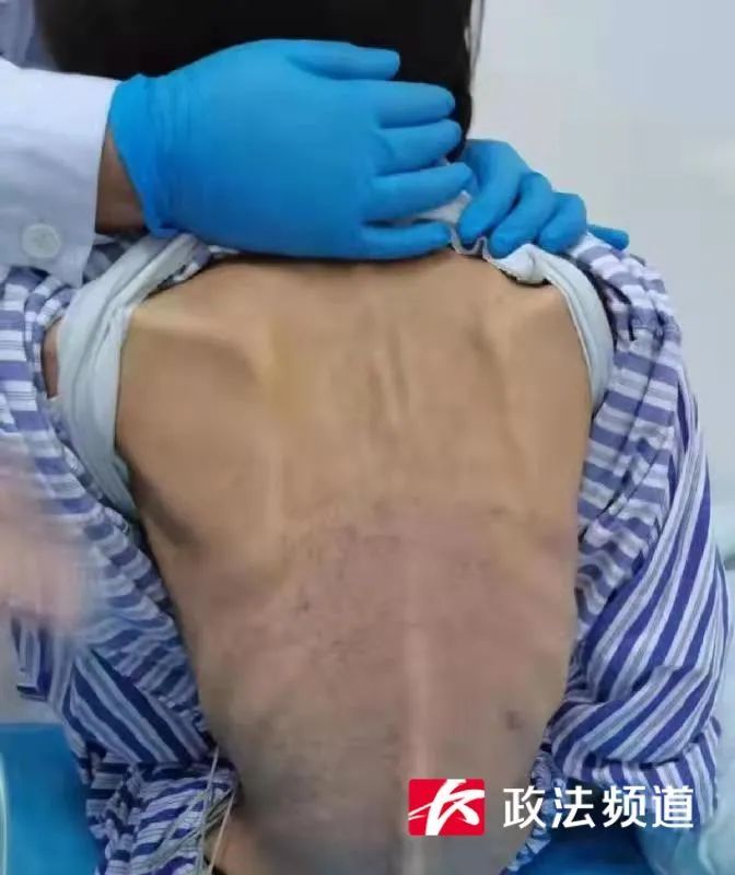 女大学生|女大学生疯狂减重！只剩60斤后晕厥，住院当天小便失禁…