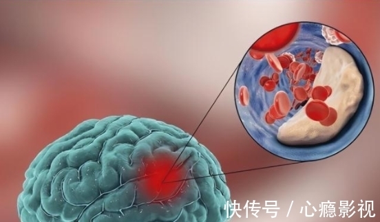 口服液|吃一次等于5斤猪油,28岁美女脑梗瘫痪,只因爱吃1种水果