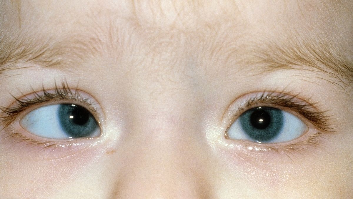 家长|6岁孩子常玩这玩具,导致黑眼珠逐渐消失,家长要当回事