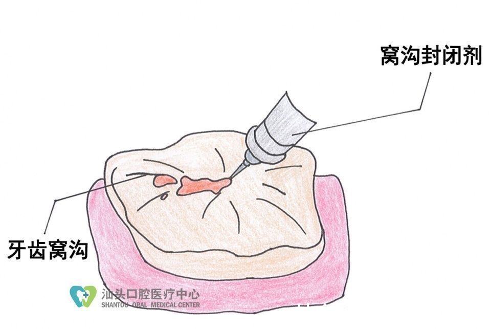 颊舌面|窝沟封闭几岁做比较好?做完还会患龋吗?关于窝沟封闭的常见答疑