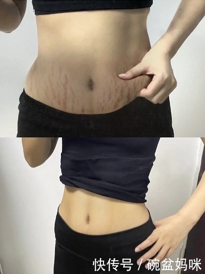 亲测|长妊娠纹丑到哭?这些技巧亲测有效!远离西瓜肚,还你少女肚!