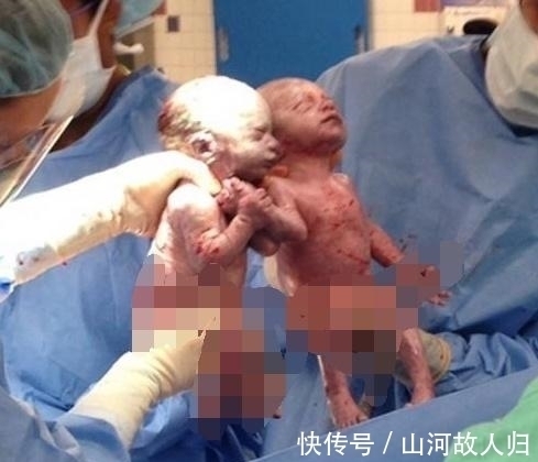 奇迹|孕妇摔倒导致双胞胎死在腹中,孕妇抱着不松手,之后奇迹发生了