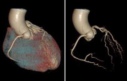 济南南郊医院已成功开展冠状动脉CT强能力，促提升| 冠状动脉
