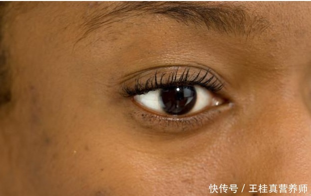 蜘蛛痣|转氨酶为何会升高？提醒：不想肝病找上门， 3种食物要少吃