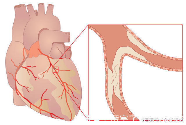 高血脂|高血脂“克星”大公开!坚持做三件事,血管干净,血脂乖乖听话!