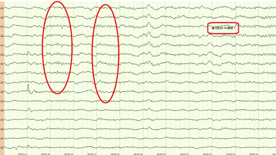心跳骤停|医生,我爸还能醒吗?会不会变成植物人?
