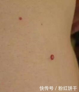 慢性肝炎|身体忽然出现两种痣,可能是你肝脏有问题,要及时排毒素了