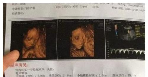 孕检|孕检时，B超单上的这3个数据，可能代表怀了个“小帅哥”
