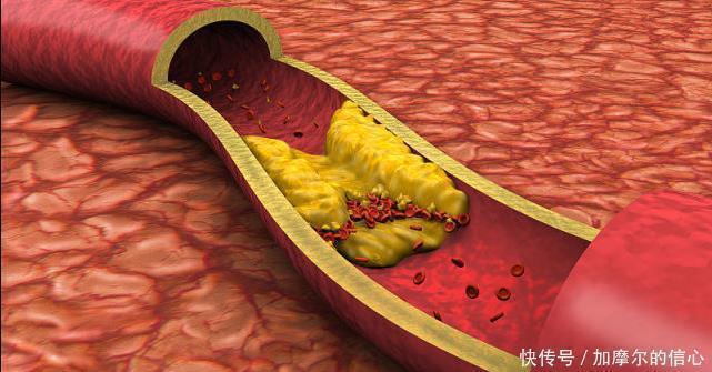 血脂|107岁长寿老人,年轻像67岁,秘诀不是多运动,而是3件事