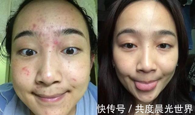 红霉素|红霉素加它敷脸,半个月不到,痘痘、痘印都没了,皮肤还变得嫩滑!