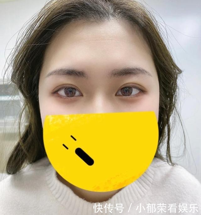 脸部|整容失败的“风险”有多大？额头凹陷、眼皮肉条，看完你还心动吗