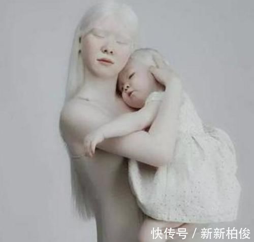 元气满满|“妈妈,我怕光”,姐妹俩出生全身雪白,网友:父母太不负责任