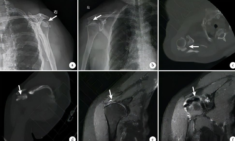 钙化性肌腱炎|长在肩膀上的“结石”:6旬阿姨肩膀半夜痛醒误以为肩周炎,原来是肩袖钙化性肌腱炎