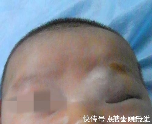 症状|宝宝脸上是海绵状血管瘤吗?家长只要看是否出现这些症状