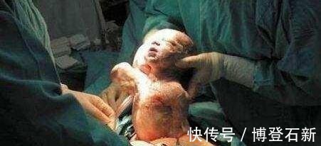 宝宝|产妇自述“胎儿太调皮，宝妈‘顺转剖’6斤小胖妞”