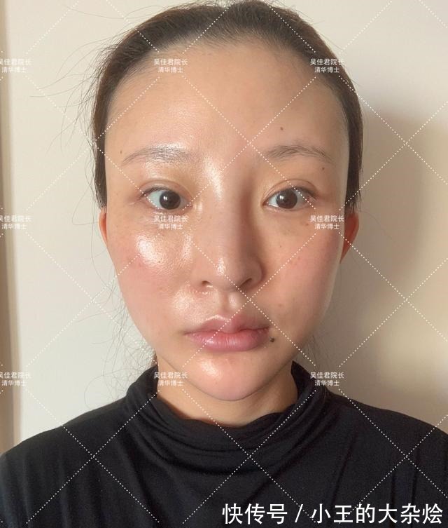 面部 做过3次线雕的她,为什么还要跑来做拉皮手术!