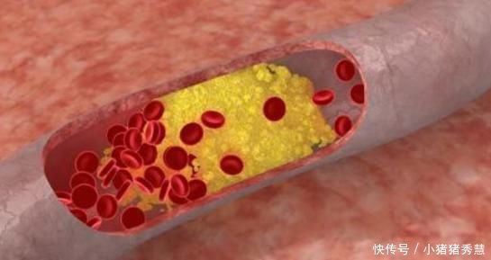 血脂|高血脂还能否吃鸡蛋?老中医:鸡蛋如此吃,好处数不胜数