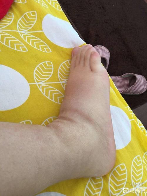 尿酸高的人，若身体出现这3种现象，已经影响肾脏，平常多做这3点