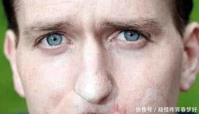 无四肢无嘴唇男子走红,接受手术后成这般,眼神让人心碎!