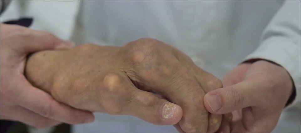 关节|被“石头”啃掉膝关节，男子几乎无法直立行走